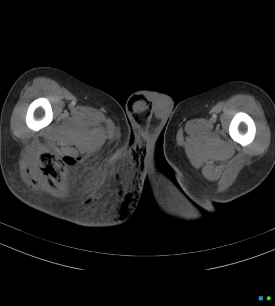 CT of Fournier gangrene with spontaneous perforation of rectal cancer - Case courtesy of Dr Chris O'Donnell, Radiopaedia.org, rID: 16849