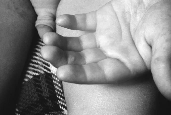 Left hand of a 2 year-old child, who after having received a smallpox vaccination, sustained an “accidental implantation” of the newly-introduced vaccinia virus. Note the left middle finger, and the lesion on this appendage.Adapted from Public Health Image Library (PHIL), Centers for Disease Control and Prevention.[3]