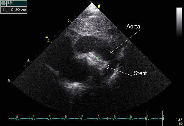 An echocardiogram of a stented persisting ductus arteriosus. One can see the aortic arch and the stent leaving.