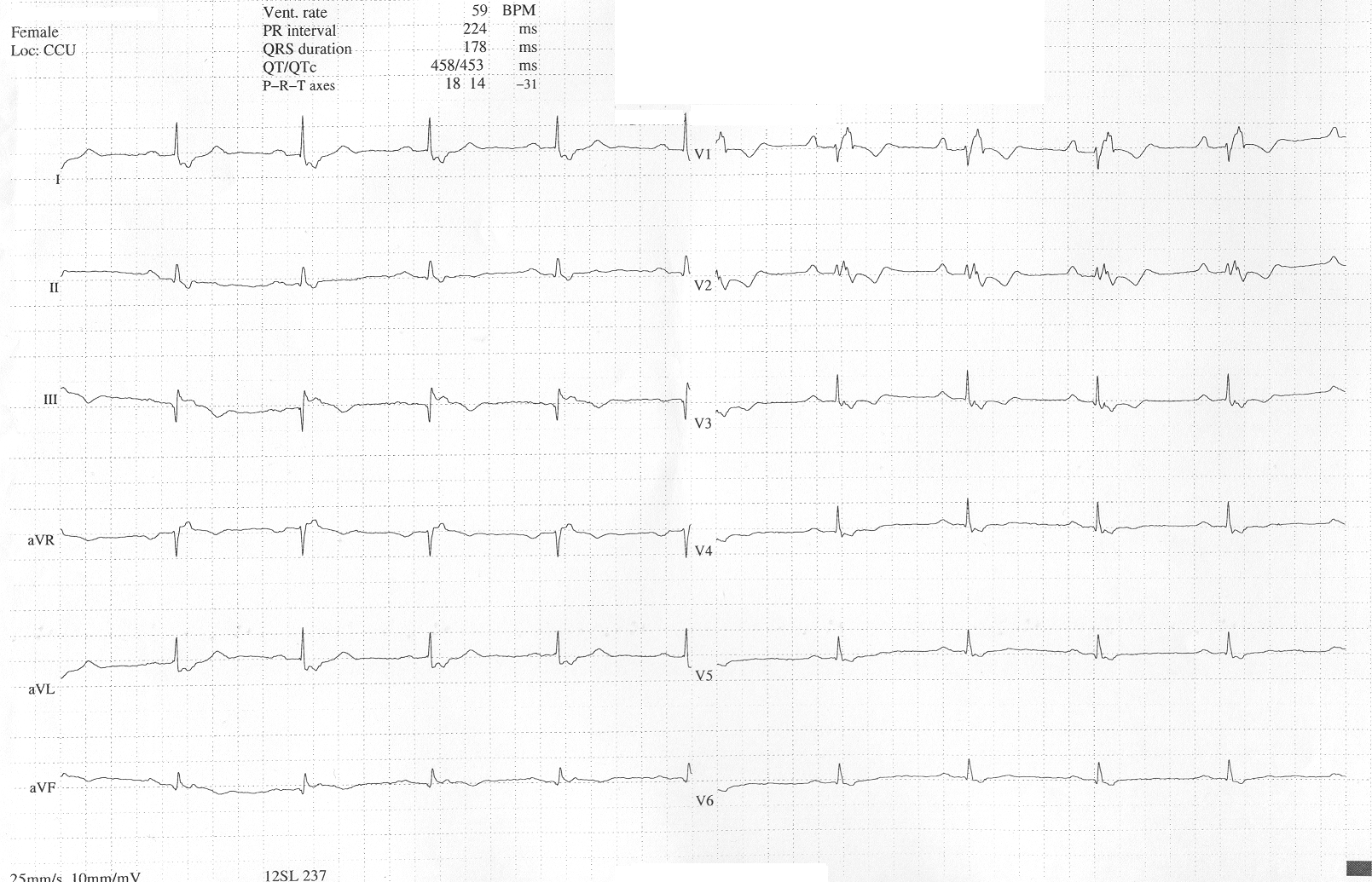 File:Ebstein's anomaly ECG.png