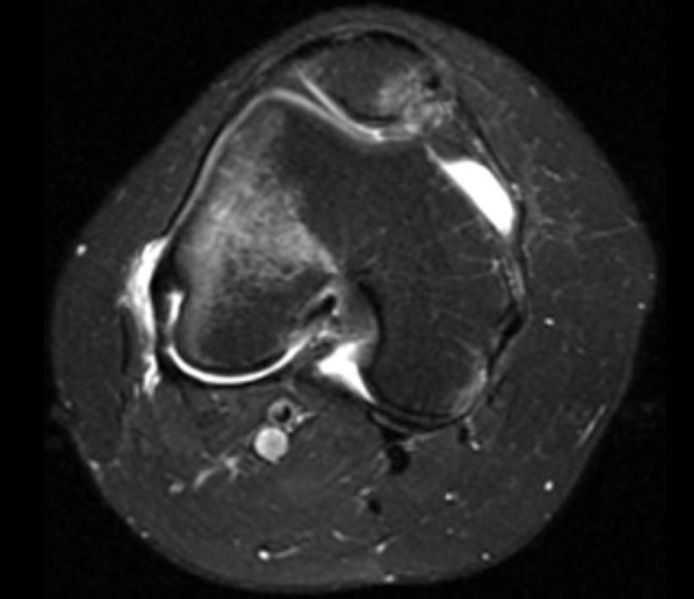 Lateral patellar dislocation Image courtesy of RadsWiki and copylefted