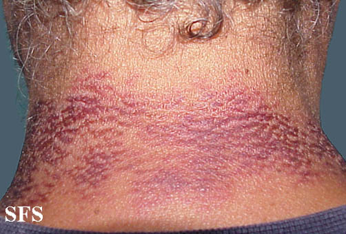 Pellagra. Permission from Dermatology Atlas.[5]