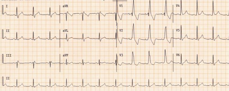 ECG from the same patient in sinus rhythm. The QRS complex is very similiar.