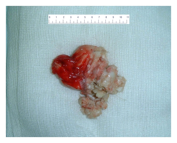 The macroscopic image of the surgical extract of a submental dermoid cyst.[4]