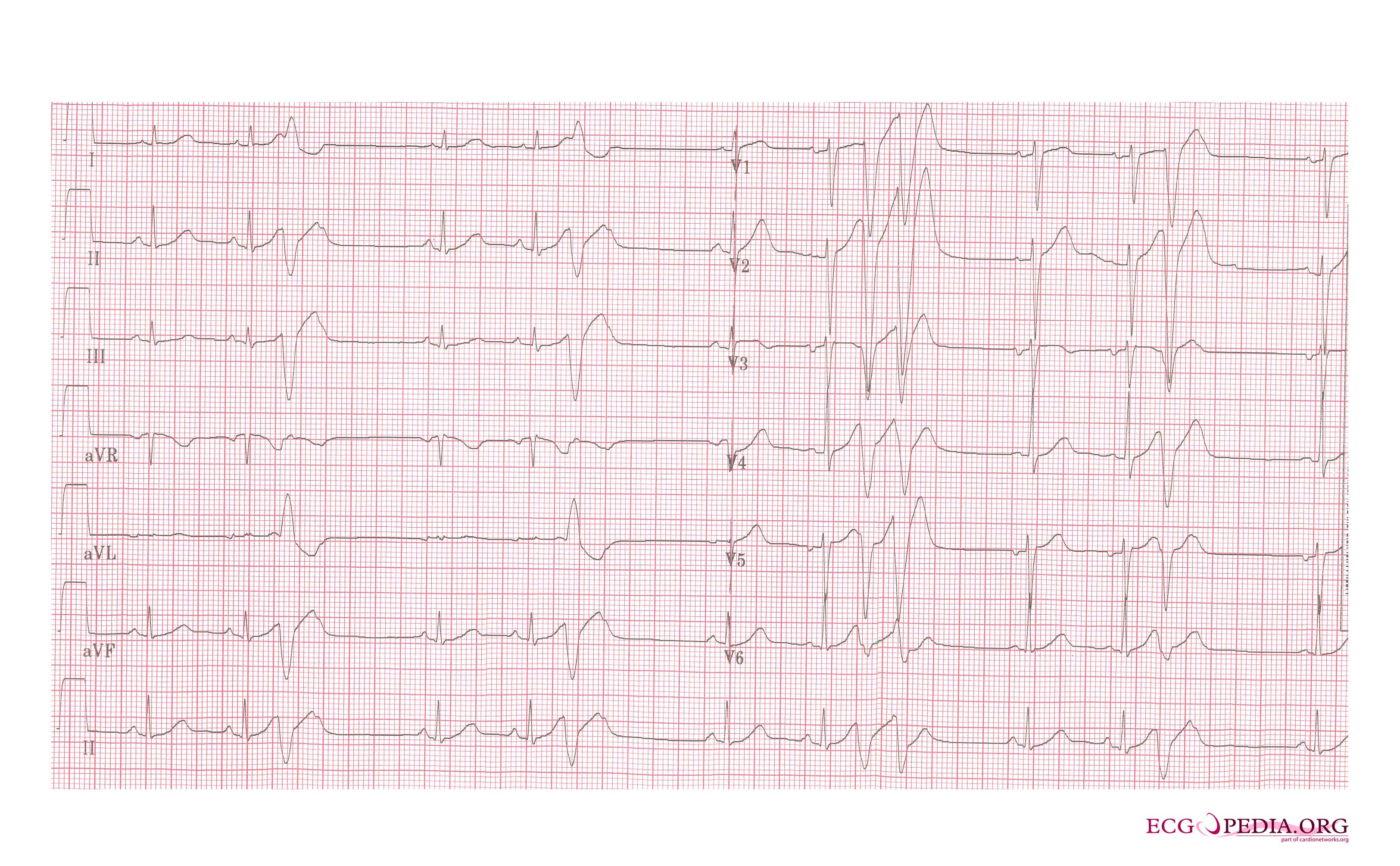 Arrhythmias in a patient with short coupled torsade de pointes: frequent short coupled extrasystoles[8]