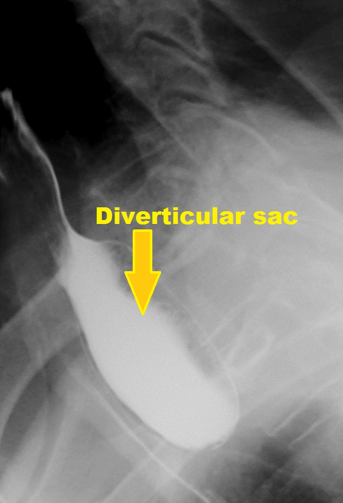 Barium swallow graphy: Zenker's diverticulum-Lateral view Source:Radiopaedia[4]
