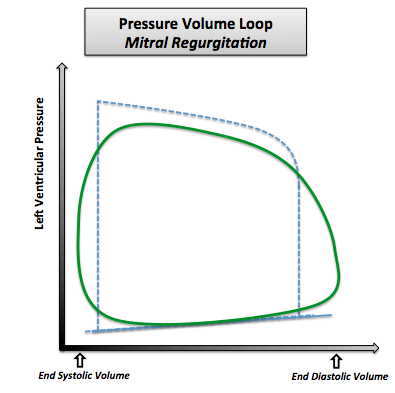 Pressure volume loop in case of mitral regurgitation. Note that the normal pressure volume loop is in dotted line.