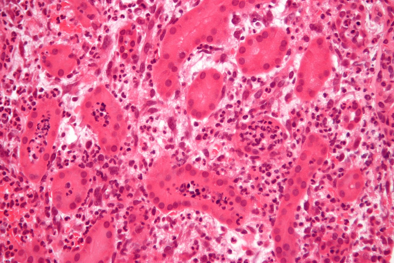 Acute Pyelonephritis with neutrophils within the tables and interstitium. Source: Libre Pathology[17]