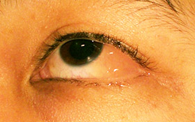 One eye with conjunctivitis.