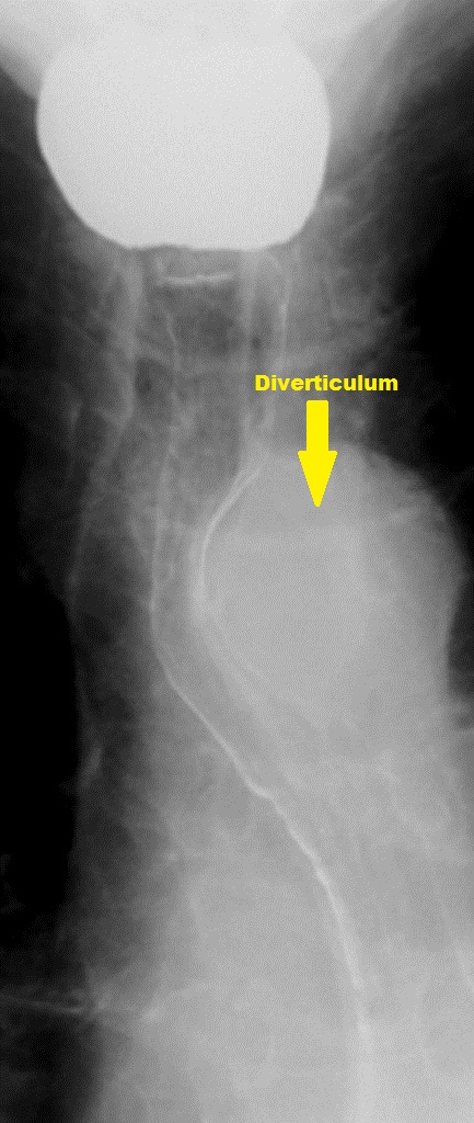 Barium swallow graphy: Zenker's diverticulum-Frontal view Source:Radiopaedia[3]