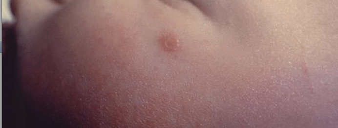 Lateral view of a 4 month-old infant’s face with a single varicella-zoster, otherwise known as chickenpox. From Public Health Image Library (PHIL). [27]