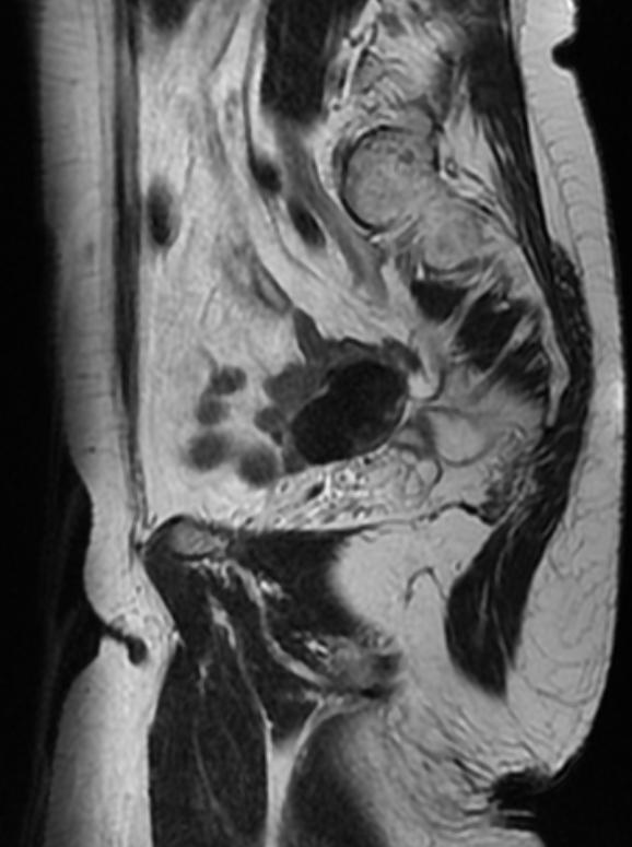 File:Ovarian fibroma MRI 003.jpg