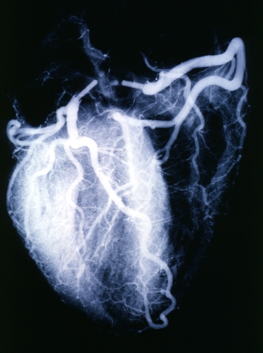 Angiogram: X-ray postmortem normal coronaries