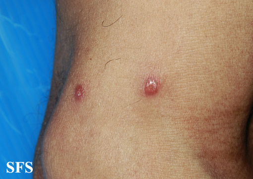 Rosai-dorfman disease. Adapted from Dermatology Atlas.[4]