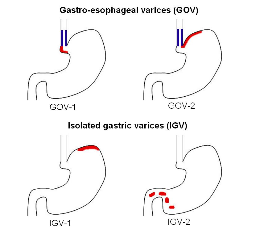 The Sarin classification of gastric varices identifies two types of gastroesophageal varices, where esophageal varices are found concurrently, and two types of isolated gastric varices, found in the absence of esophageal varices.