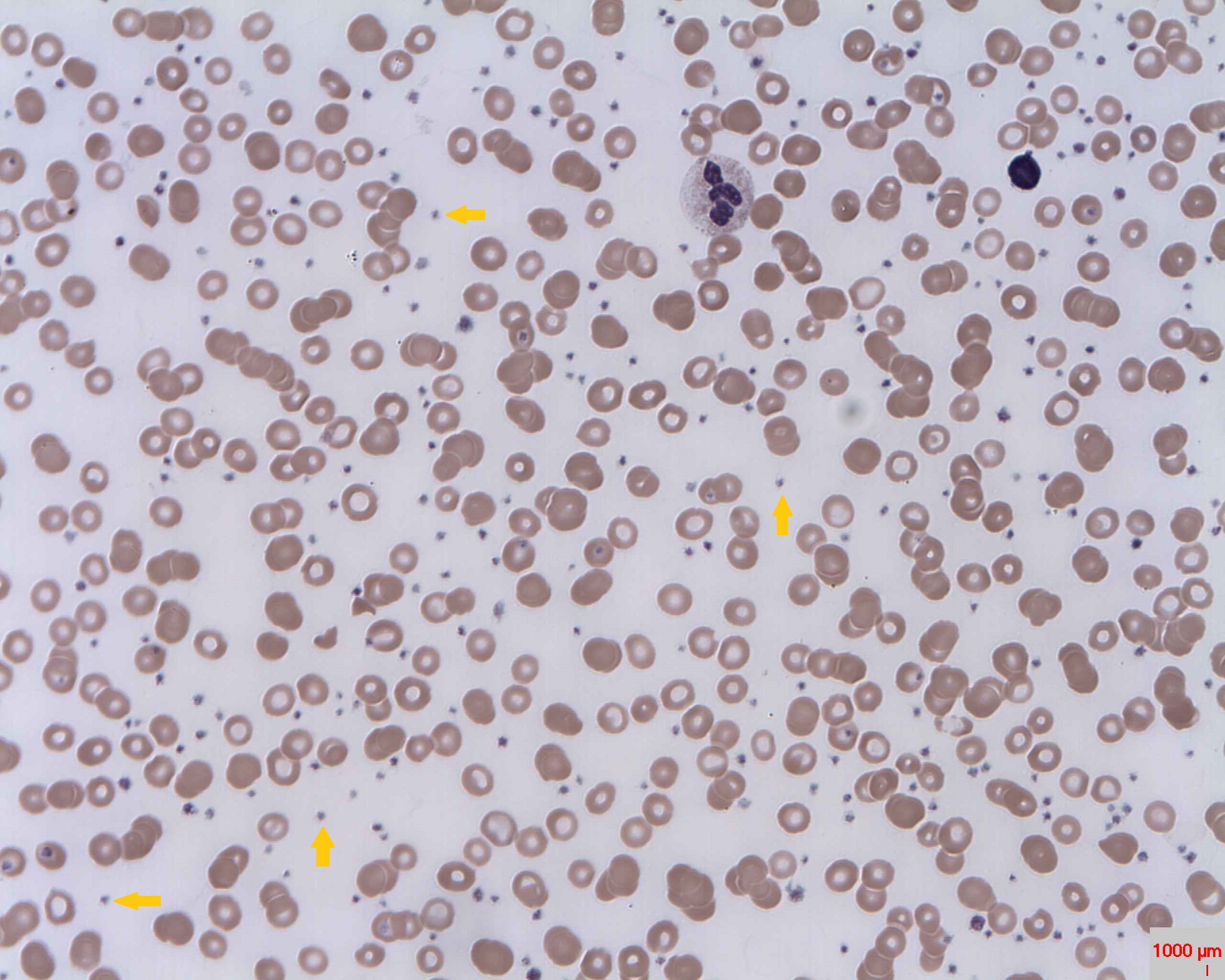 File:Thrombocytosis.jpg