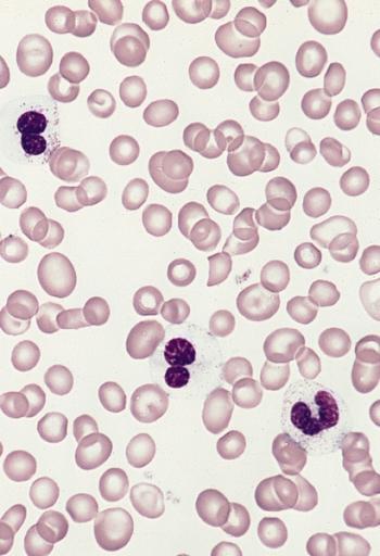BONE MARROW: HYPEREOSINOPHILIC SYNDROME Blood smear from a 50-year-old male with a 3-year history of hypereosinophilic syndrome with progressive bone marrow failure and multiple organ involvement. The three eosinophils show marked hypogranulation. (Wright-Giemsa stain)