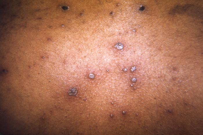 Chickenpox lesions on a patient’s back, which were displaying the characteristic “cropping” distribution, or manifesting themselves in clusters. From Public Health Image Library (PHIL). [27]