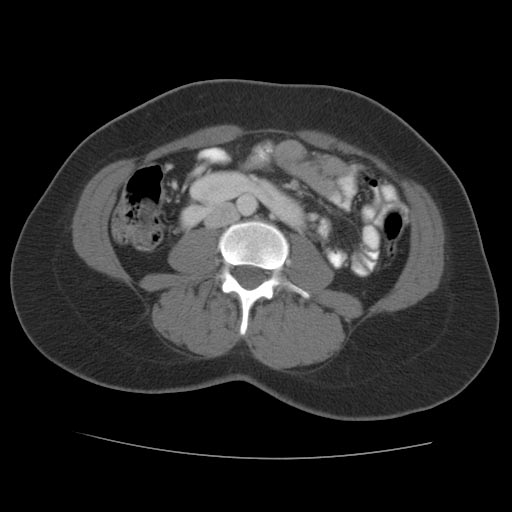 CT image demonstrates a horseshoe kidney