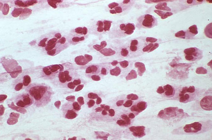 Gram stain of urethral discharge. Note that, many PMNs without intracellular bacteria in favor of nongonococcal urethritis.