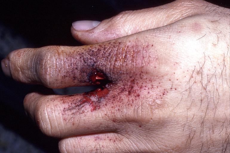 Hand, gunshot entrance wound, intermediate range, powder burns ("freckling")