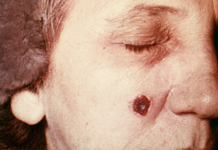 "Anthrax, skin of face, 13th day”Adapted from Public Health Image Library (PHIL), Centers for Disease Control and Prevention.[21]