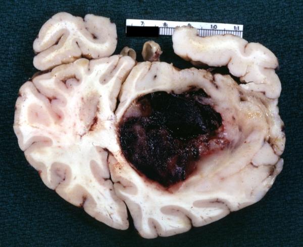 Brain: Oligodendroglioma: Gross; fixed tissue, coronal section, cerebral hemispheres, large hemorrhagic lesion in one hemisphere
