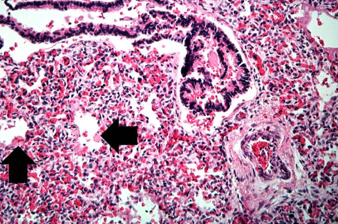 This high-power photomicrograph shows an airway with adjacent lung tissue. Some alveoli have hyaline membranes (arrows). There is severe congestion of the interstitium throughout this section.