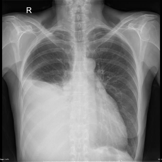 Large unilateral right sided effusion. Heart is enlarged, especially the left lateral appendage.