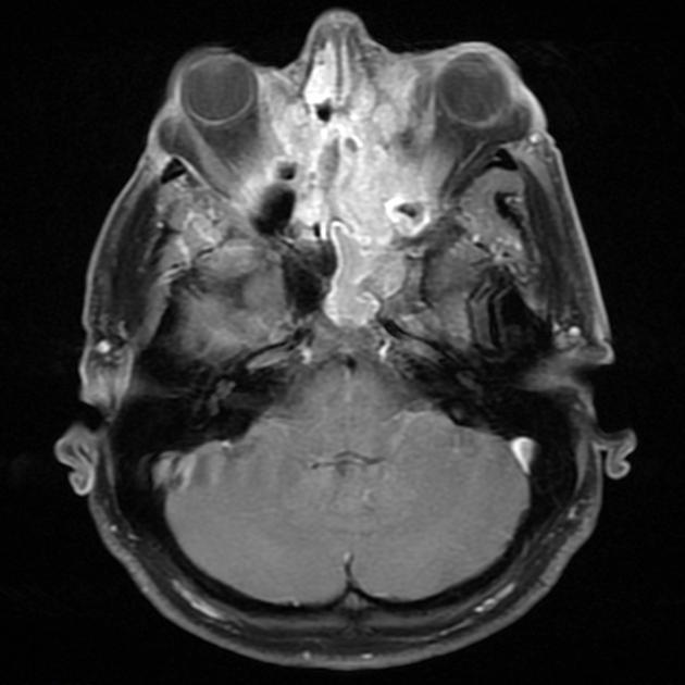 MRI showing T1 C+ fat sat image of esthesioneuroblastoma[2]