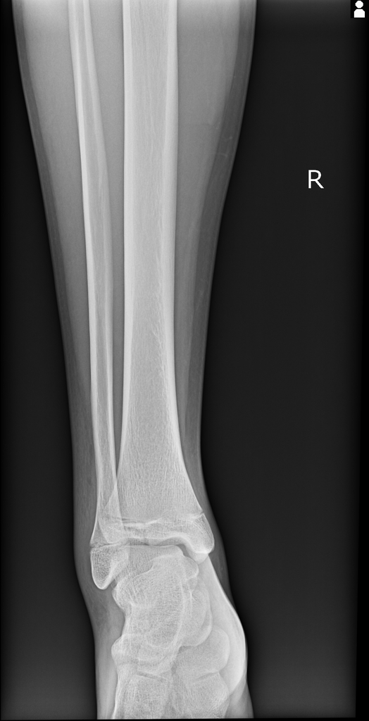 File:Tillaux-fracture-6.jpg
