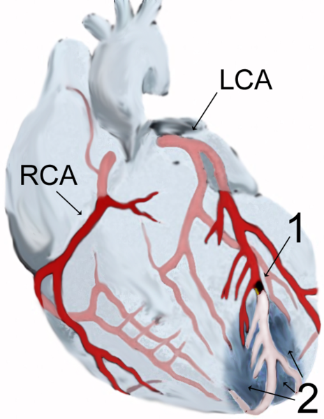 Diagram of a myocardial infarction.