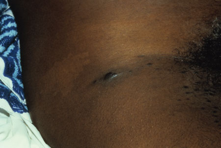 Kaposi Sarcoma/ HHV-8 Image obtained from U.S. Department of Veterans Affairs - Image Library [9] (Paul A. Volberding, MD, University of California San Francisco)