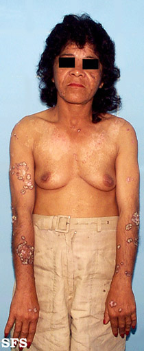 Lupus erythematosus chronicus verrucous. Adapted from Dermatology Atlas.[6]