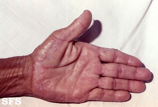 Marginal keratoderma of the palms. Adapted from Dermatology Atlas.[1]