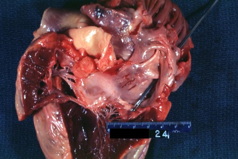 Cor Triatriatum: Gross left ventricular outflow tract appears normal