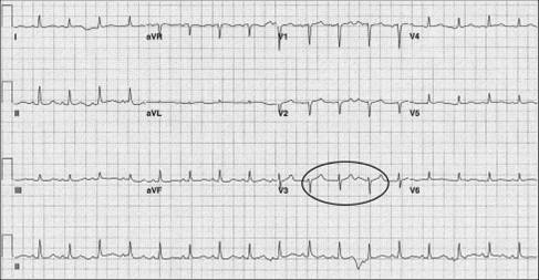 ST segment in ECG of a patient with cardiac tamponade