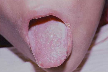 Oral Candidiasis Image obtained from U.S. Department of Veterans Affairs - Image Library [1] (Pediatric AIDS Pictoral Atlas, Baylor International Pediatric AIDS Initiative)