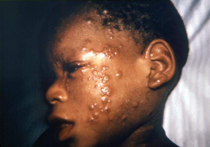 Two year-old African-American boy developed a case of eczema vaccinatum after having received a smallpox vaccination.Adapted from Public Health Image Library (PHIL), Centers for Disease Control and Prevention.[3]