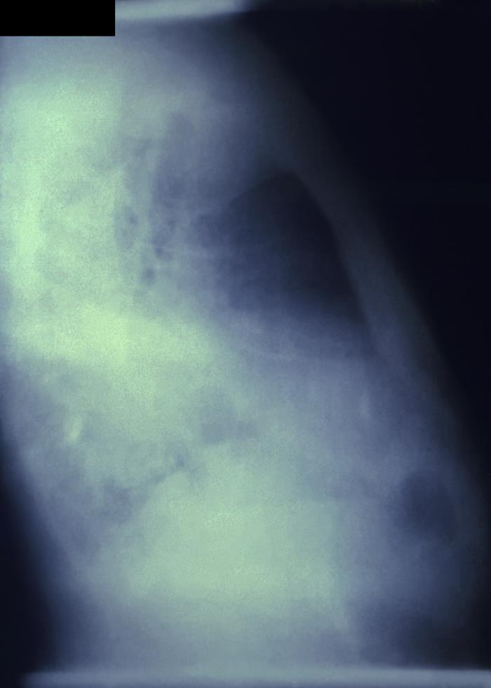 This right-lateral chest x-ray revealed evidence of a pulmonic infection 4 days after this patient had been exposed to the bacillus, Bacillus anthracis, the cause of the disease known as anthrax. Adapted from Public Health Image Library (PHIL), Centers for Disease Control and Prevention.[3]