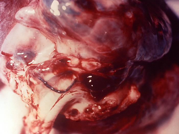 Gross pathologic posterior oblique view of a chimpanzee's lungs that had contracted fatal inhalation anthrax.” Adapted from Public Health Image Library (PHIL), Centers for Disease Control and Prevention.[20]