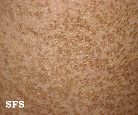 Icthyosis vulgaris. Adapted from Dermatology Atlas.[1]