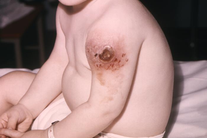 22 month-old male with Bruton’s hypogammaglobulinemia accompanied by vaccinia necrosum. Note the large necrotic area at the vaccination site.Adapted from Public Health Image Library (PHIL), Centers for Disease Control and Prevention.[3]