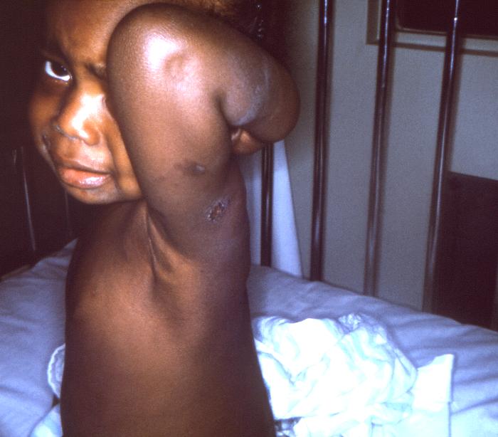 2 year-old female patient who after receiving a smallpox vaccination in her left shoulder region, developed an erythema multiforme reaction. Note left shoulder vaccination site. Adapted from Public Health Image Library (PHIL), Centers for Disease Control and Prevention.[14]
