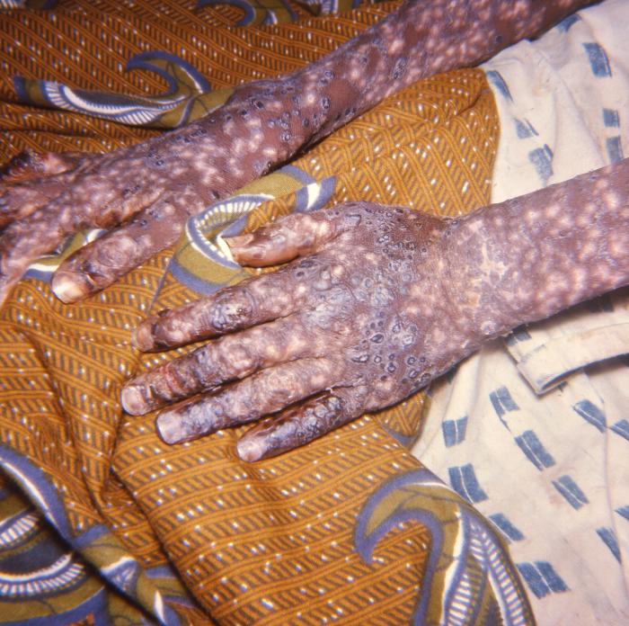 Hands of an adult smallpox patient, which display the characteristic maculopapular rash due to the smallpox virus.Adapted from Public Health Image Library (PHIL), Centers for Disease Control and Prevention.[3]