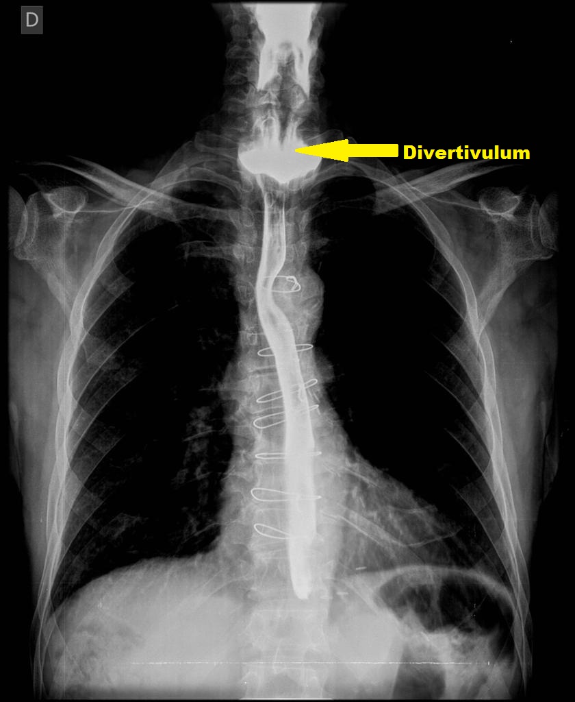 Barium swallow graphy: Zenker's diverticulum-Frontal view Source:Radiopaedia[1]