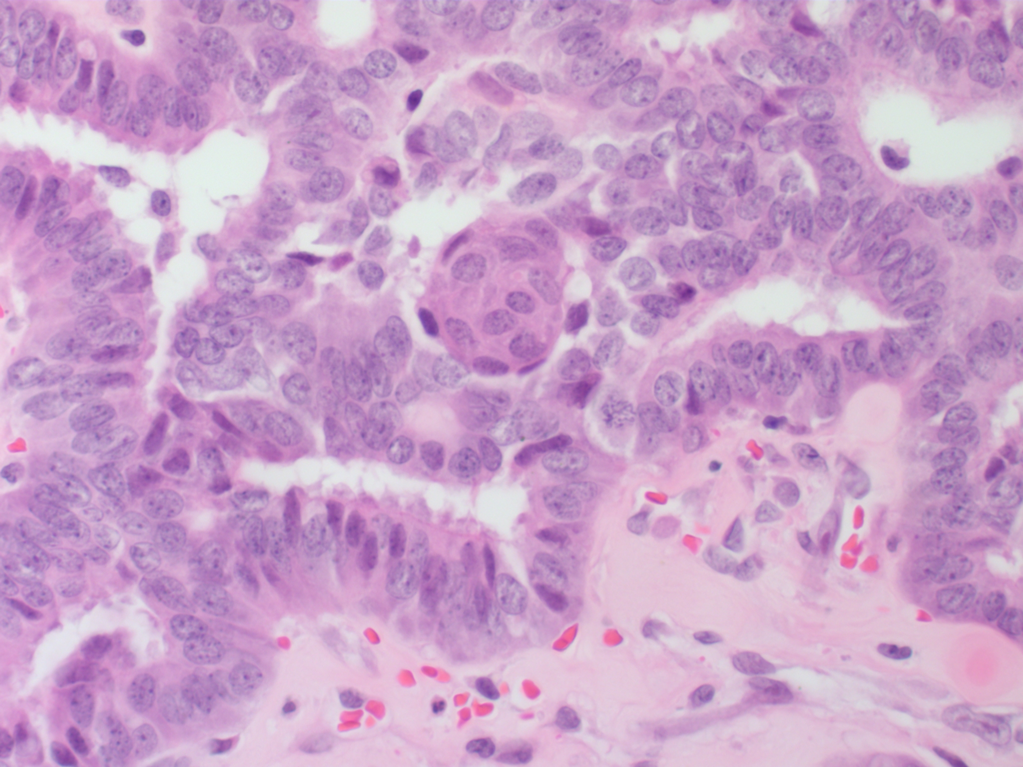 File:Thyroid PapillaryCarcinoma CribriformMorularVariant HP2 13BR (1).jpg
