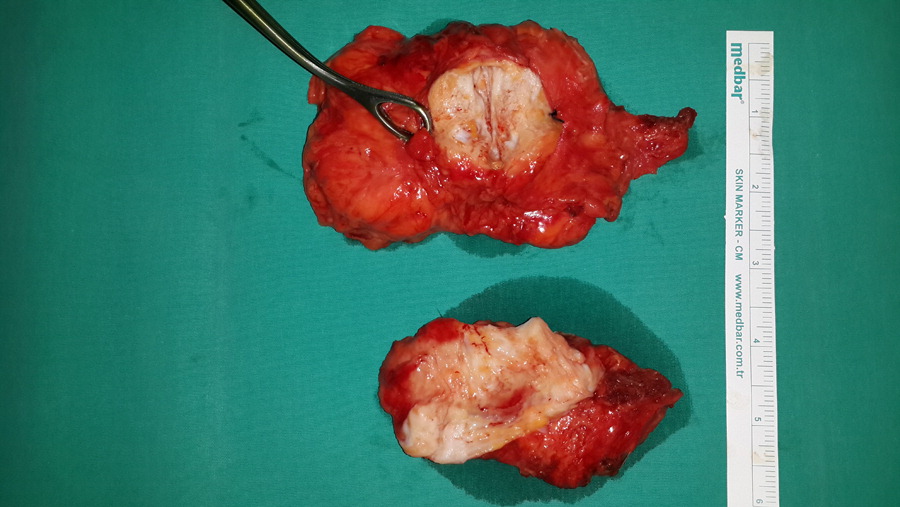 Bilateral Elastofibroma dorsi. Source:Science direct(under creative commons)[5]