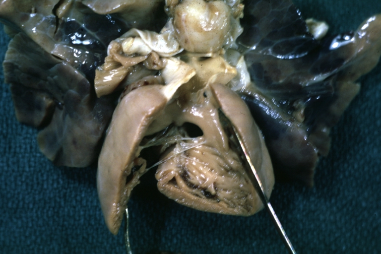 Ventricular Septal Defect Muscular: Gross, natural color, view from left ventricle with probe in defect