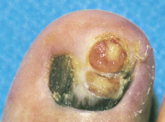 This is a subungual radial growth phase of acral-lentiginous type with two amelanotic vertical growth phase tumor nodules. Radial growth phase is just beginning to grow onto the cuticle of the nail, displaying a subtle example of "Hutchinson's sign."